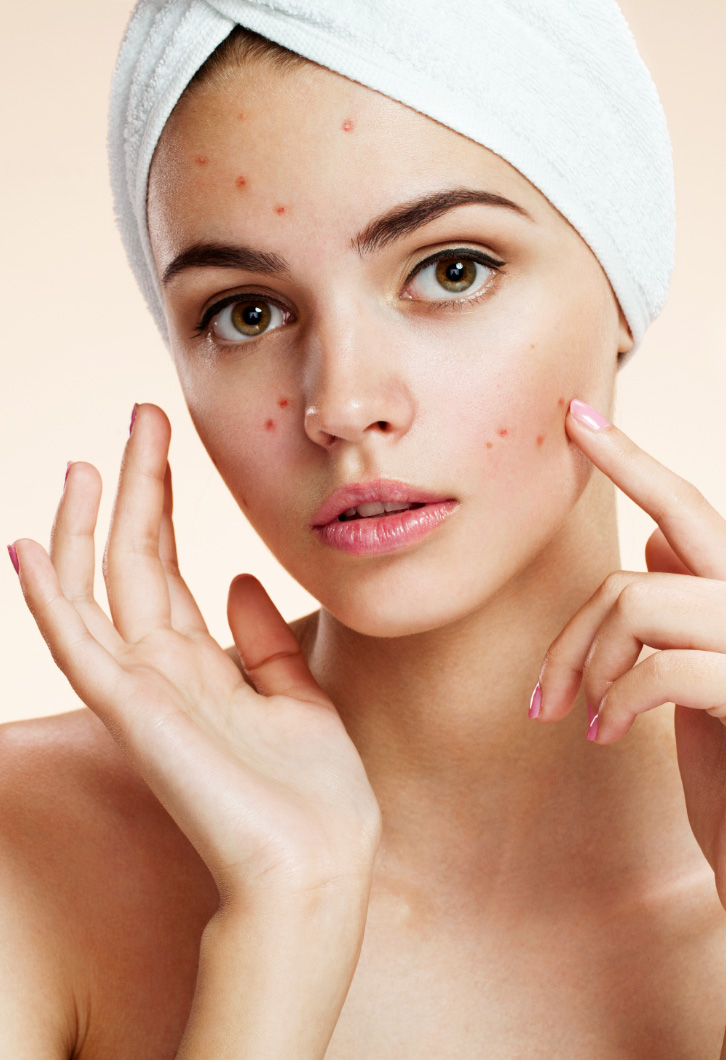 Pimples in face at aesthetic clinic in singapore